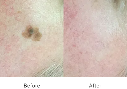 How We Diagnose Seborrhoeic Keratoses
