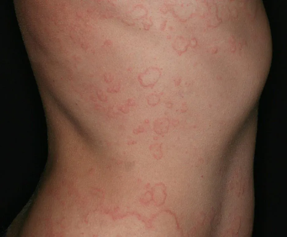 Hives – Causes, Symptoms, and Treatment